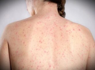 Morbillo, dagli aeroporti Usa alle scuole di Londra: dilagano gli alert