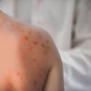 Allerta morbillo negli Usa, quarto morto in Pennsylvania: è un 18enne non vaccinato