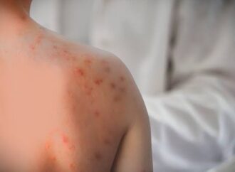 Allerta morbillo negli Usa, quarto morto in Pennsylvania: è un 18enne non vaccinato