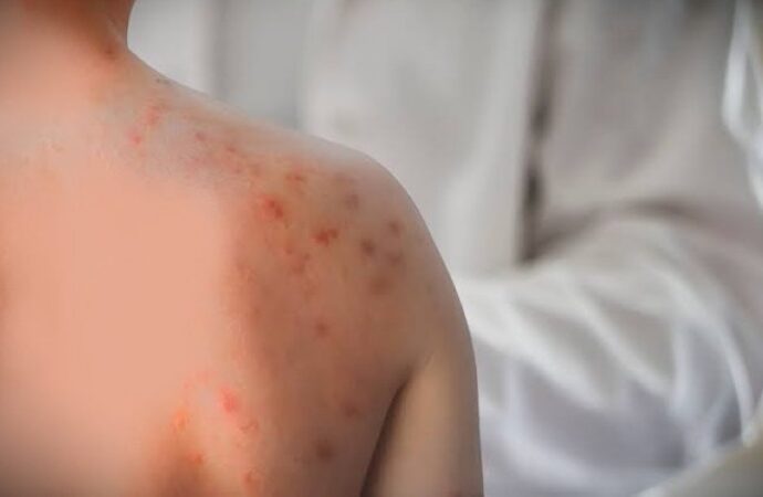 Allerta morbillo negli Usa, quarto morto in Pennsylvania: è un 18enne non vaccinato